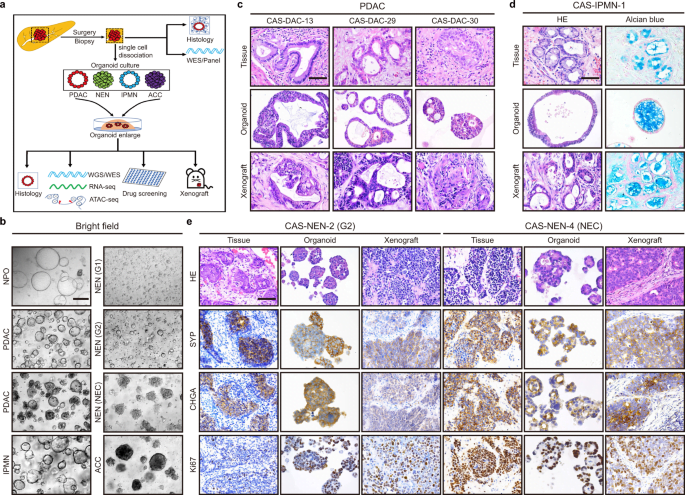 Organoid Breakthroughs: New Avenues for Pancreatic Cancer Treatment